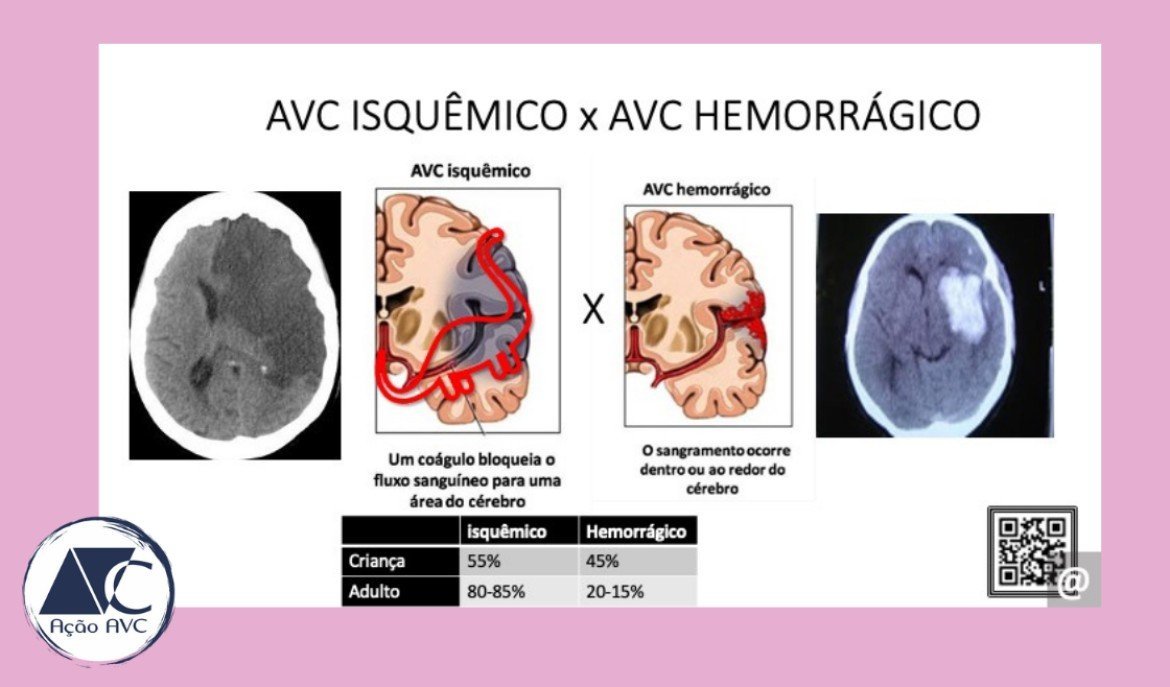 AVC (Acidente Vascular Cerebral) isquêmico e hemorrágico O que é AVC isquemico e hemorrágico?