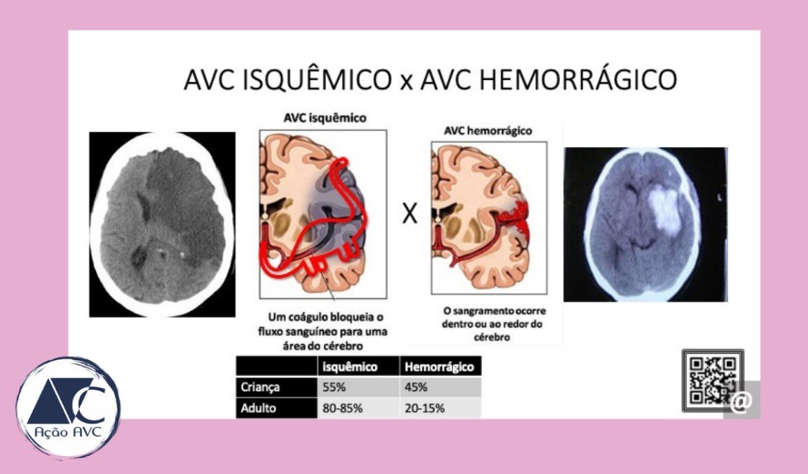 Qual A Diferença Entre Avc Isquemico E Hemorragico - ENSINO