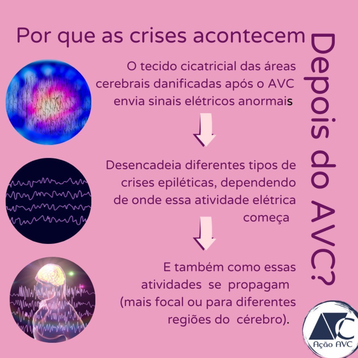 Por que as crises de epilepsia acontecem após o AVC?