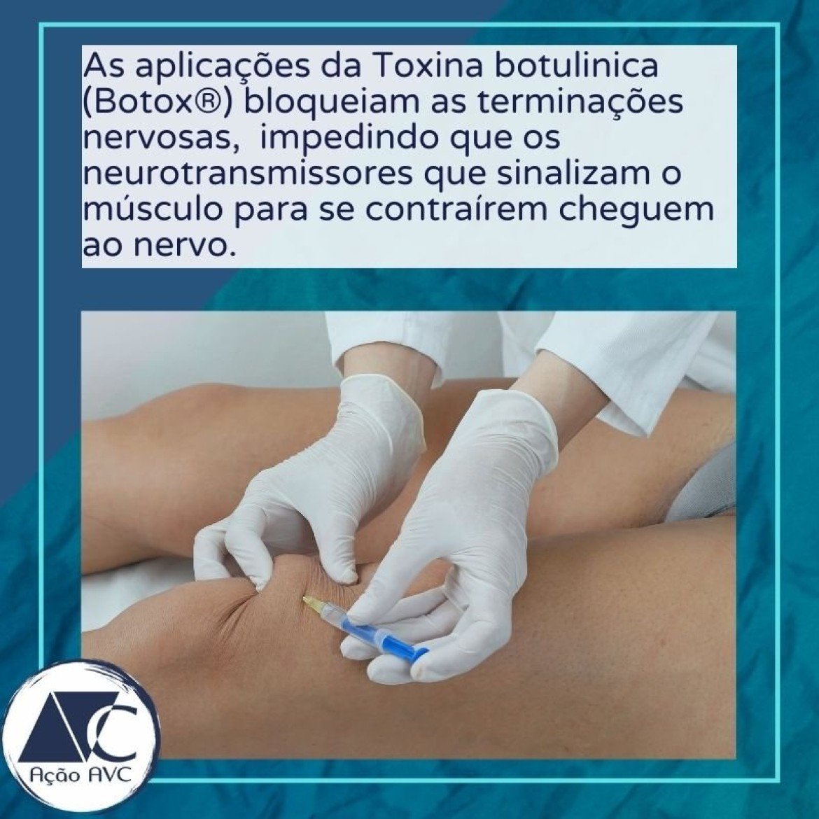 Toxina botulínica  após o AVC